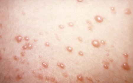 In rare chickenpox case, itchy blisters mushroom into large, rubbery nodules