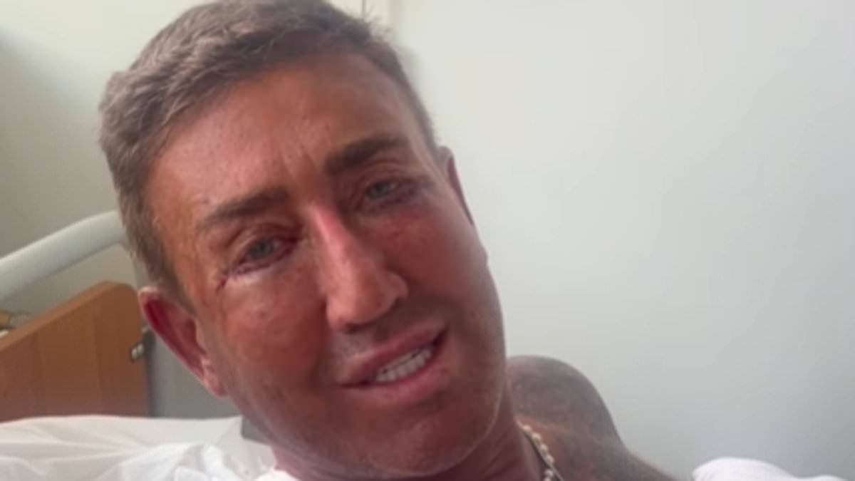 The X Factor's Christopher Maloney looks unrecognisable as he showcases results of eye bag surgery after years of filler