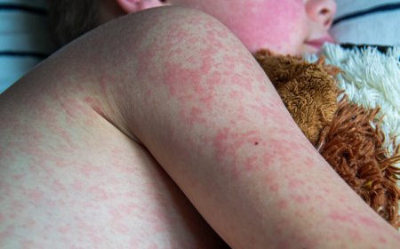 Analysis of Texas measles outbreak shows just how dangerous virus is