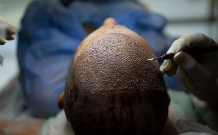 How Turkey Hacked the Hair Transplant Industry