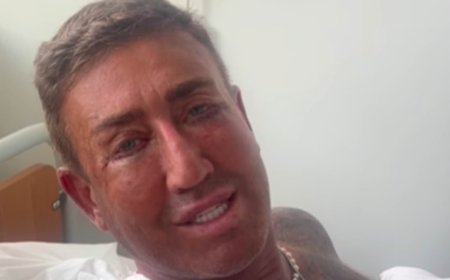 The X Factor's Christopher Maloney looks unrecognisable as he showcases results of eye bag surgery after years of filler