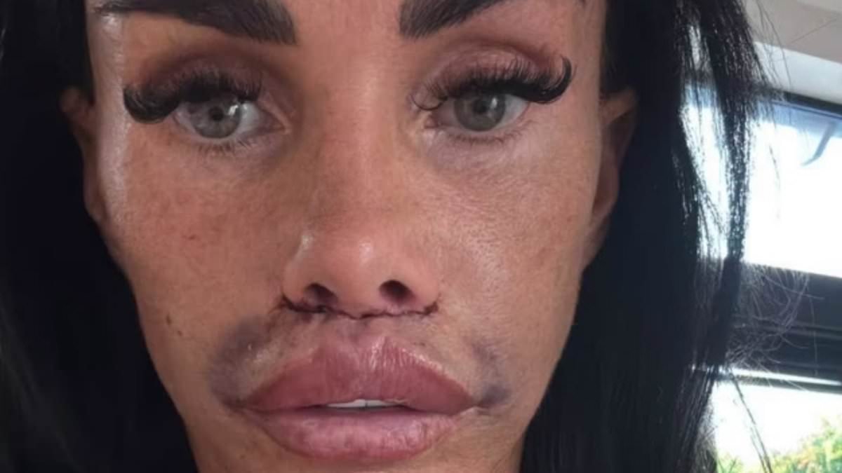 Katie Price shows off her swollen face in new update after undergoing lip filler corrective surgery
