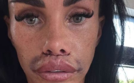 Katie Price shows off her swollen face in new update after undergoing lip filler corrective surgery