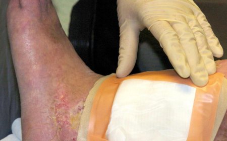 Second carcass-eating fly species cleared by FDA for maggot wound therapy