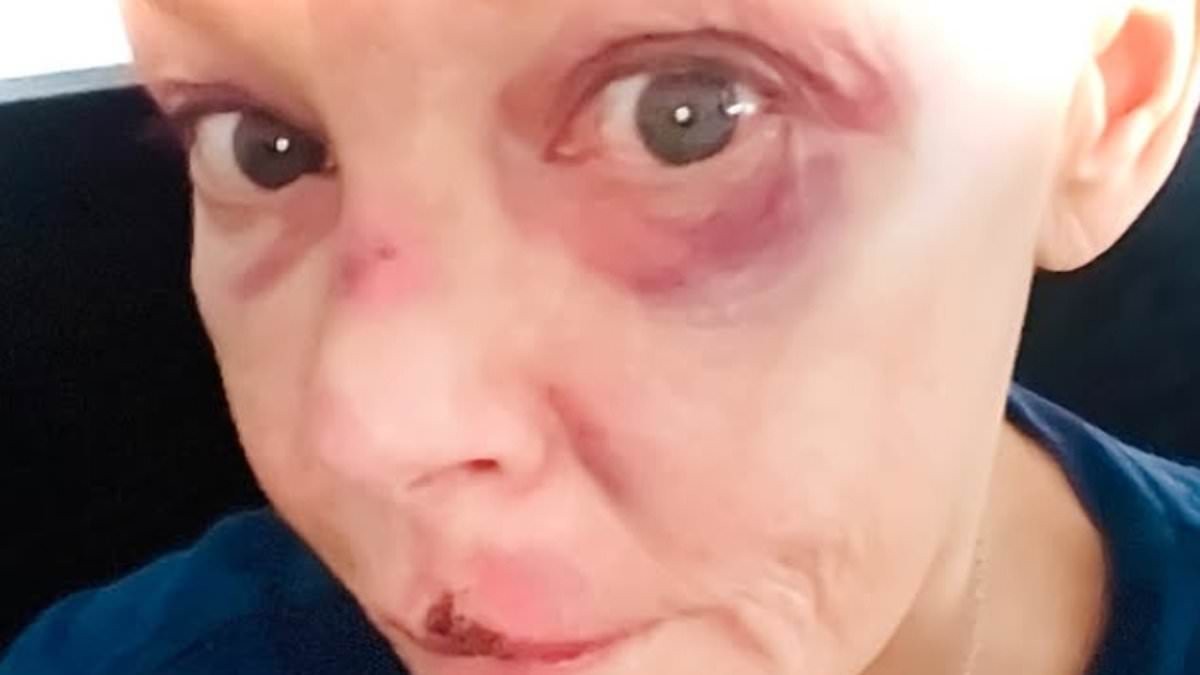 Gail Porter reveals black eye and bruised cut lip after she was knocked down the stairs at a London tube station as she urges keyboard warriors to be 'kind to her'
