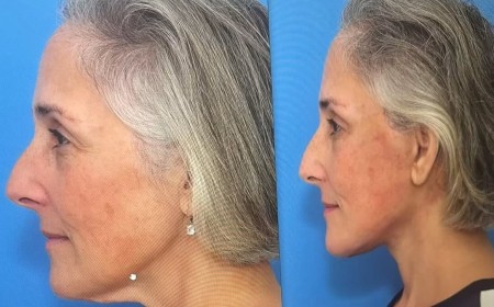 Ricki Lake, 57, shares shocking before-and-after facelift photos as she marks two-year anniversary of her plastic surgery procedure