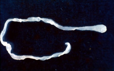 Surprised doctors find 10-inch worm in man's groin during elective surgery