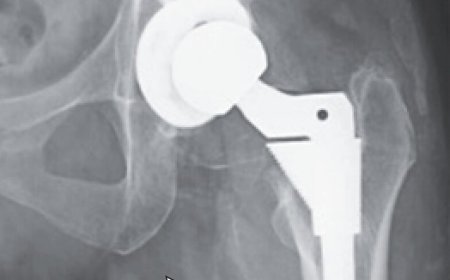 Woman's puzzling decline turns out to be cobalt poisoning from hip replacement