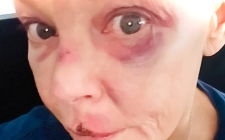 Gail Porter reveals black eye and bruised cut lip after she was knocked down the stairs at a London tube station as she urges keyboard warriors to be 'kind to her'