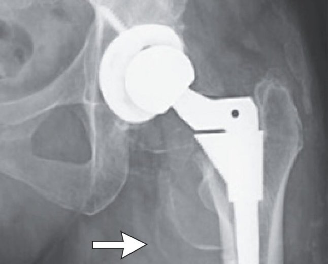 Woman's puzzling decline turns out to be cobalt poisoning from hip replacement