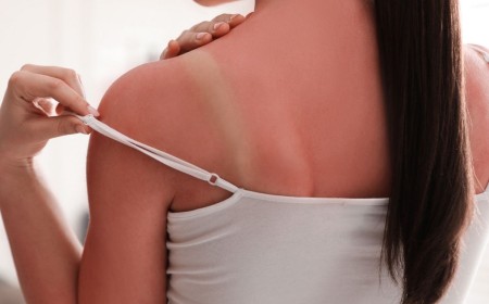 Sunburned? A Celeb Esthetician’s Secret to Prevent Peeling