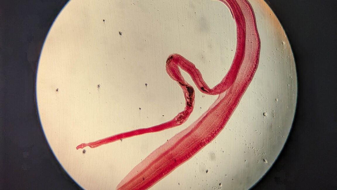 Woman's brain worm infection confirmed after eggs grow tails in lab test