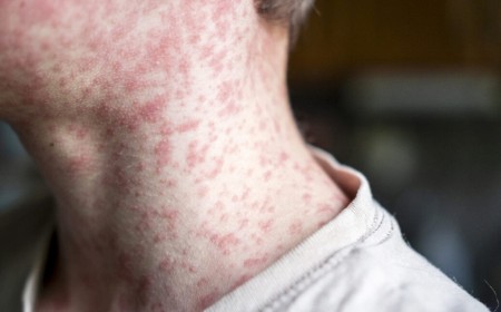 18-year-old dies of measles in PA from severe neurological complication