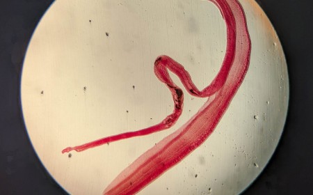 Woman's brain worm infection confirmed after eggs grow tails in lab test
