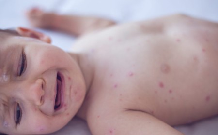 Measles killed 6-week-old baby, coroner confirms after RFK Jr. disputed deaths
