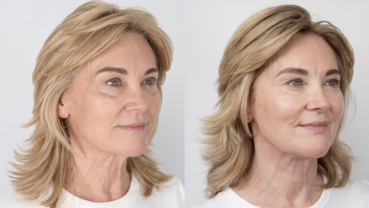 Anthea Turner, 66, shows off the results of her non-surgical facelift in a before and after shoot