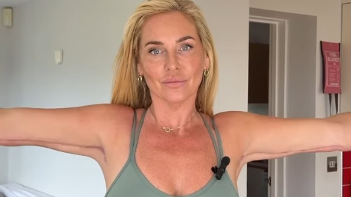 Josie Gibson gives an update on her scars after having an £8,000 arm lift amid lipoedema battle - as she reveals plans to have three more surgeries on her legs
