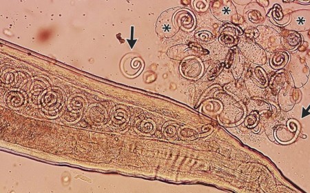 Worms mate in man's eyes, get plucked out right before larvae burst out